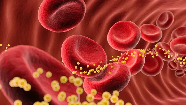 Colesterol ruim (LDL) elevado