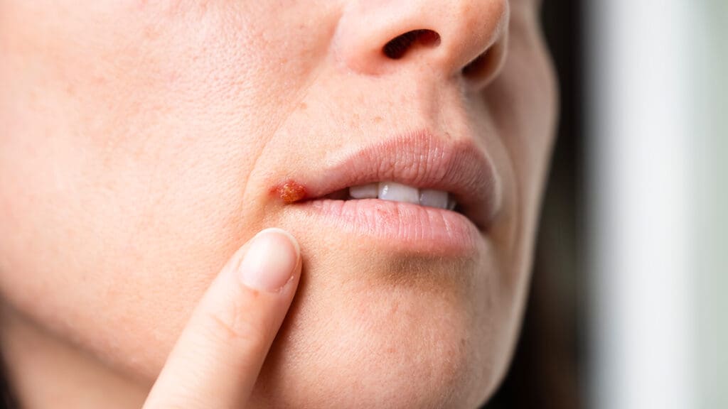 herpes labial