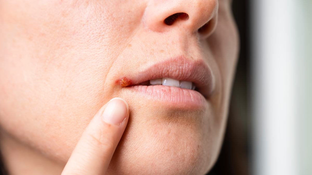 herpes labial